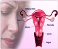 Fibroids in Uterus