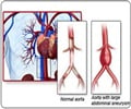 Takayasu Arteritis - Support Groups