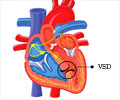 Congenital Heart Disease – Septal Defects - Ventricular Septal Defect