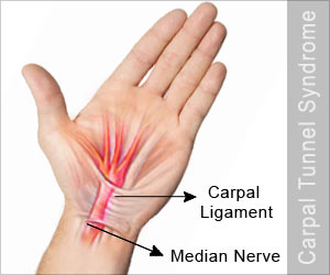 Carpal Tunnel Syndrome-Causes-Signs-Symptoms-Diagnosis-Treatment-Prevention