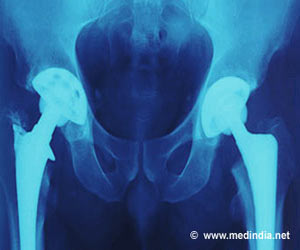 Hip replacement 
