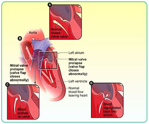 Mitral Valve Prolapse (MVP) - Causes - Symptoms and Complications ...