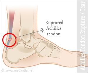 Achilles Tendon Rupture or Tear - Symptoms, Causes, Diagnosis, Treatment