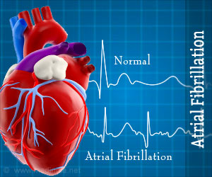 Atrial Fibrillation - Causes, Symptoms, Diagnosis, Treatment ...