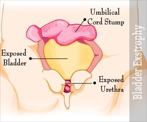 exstrophy of the bladder