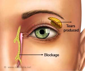 Blocked Tear Duct Causes Symptoms Diagnosis Treatment Faqs