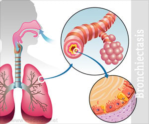 Bronchiectasis - Causes, Symptoms, Diagnosis, Prognosis, Treatment