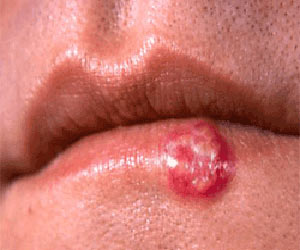 Cold Sores - Causes Outbreak Symptoms Treatment FAQs