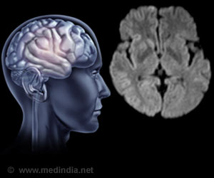 Creutzfeldt-Jakob Disease / Transmissible Spongiform Encephalopathy