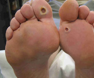 Foot Ulcer Causes Types Symptoms Treatment Prevention