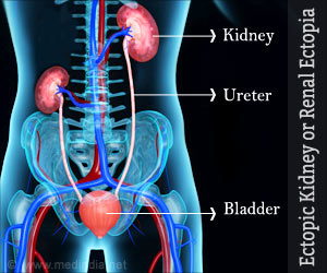 Ectopic Kidney | Renal Ectopia - Causes, Symptoms, Diagnosis, Treatment ...