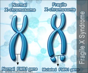 Fragile X Syndrome - Causes Symptoms Signs Diagnosis Treatment