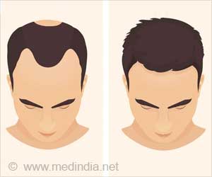 Waking up hair follicles could cure baldness  Health  Hindustan Times