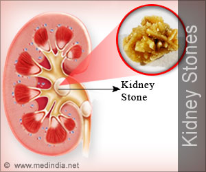 Diet for Kidney Stones