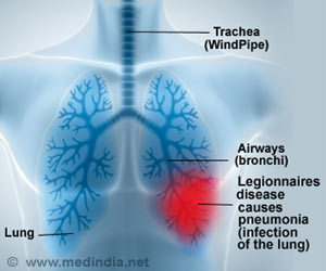 Legionnaires’ disease - Symptoms - Causes - Risk Factors - Diagnosis ...