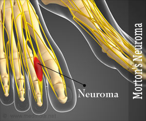 Morton's Neuroma - Causes, Symptoms, Diagnosis, Treatment, Prevention