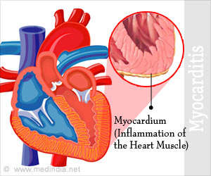 Myocarditis - Types, Causes, Symptoms, Complications, Treatment, Prognosis