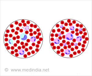 Neutropenia Causes Symptoms Diagnosis Treatment