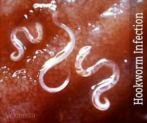 Benign Crystal Protein Brings Hope for Billions of Hookworm Sufferers