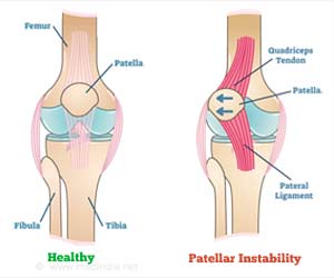 patellar instability symptoms