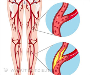 New Technique To Identify Plaque In Peripheral Atherosclerosis