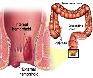 Do you know which doctor should you consult if you have Hemorrhoids. This and other commonly asked questions about this condition.