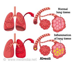 Treatment for Pneumonitis