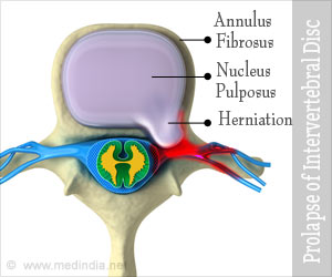 Prolapse of Intervertebral Disc - Causes, Symptoms, Signs, Diagnosis ...