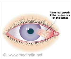 Pterygium - Stages, Types, Causes, Symptoms, Diagnosis, Treatment ...