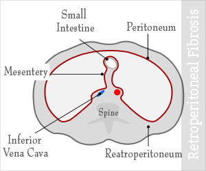 Retroperitoneal Fibrosis | Ormond's Disease - Causes, Diagnosis, and ...