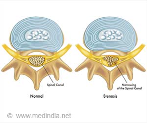 Spinal Stenosis Patient Finds Instant Relief After Years of ...