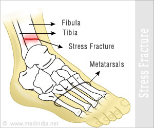 stress fracture in lower back