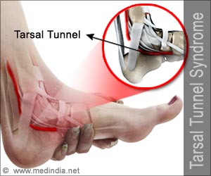 Tarsal Tunnel Syndrome Causes Symptoms Signs Diagnosis Treatment