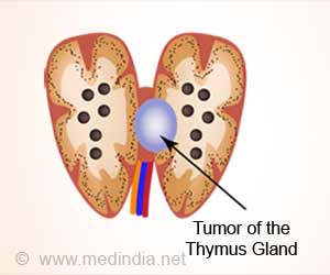 Thymoma And Thymic Carcinoma - Causes, Symptoms, Diagnosis & Treatment