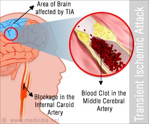 Transient Ischemic Attack - Risk Factors Symptoms Diagnosis Treatment FAQs