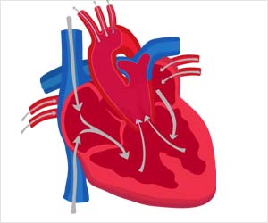 Truncus Arteriosus - Types, Risk Factors, Clinical Features, Management ...