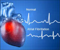 Tiny Deletion in Heart Protein Causes Adult Atrial Fibrillation