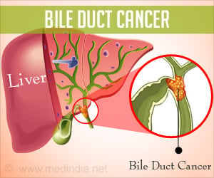Test Your Knowledge on Bile Duct Cancer