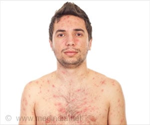 Test Your Knowledge on Chickenpox