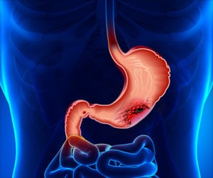 Test Your Knowledge on Gastric Cancer