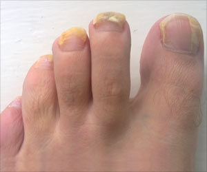 Test Your Knowledge on Nail Infection