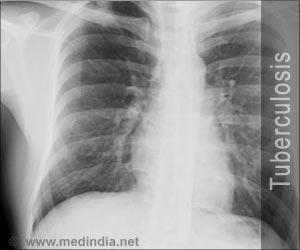 Quiz on Tuberculosis
