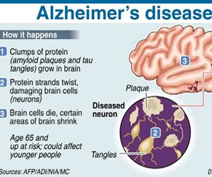 Study Links Alzheimer's Disease to Hunger Hormone