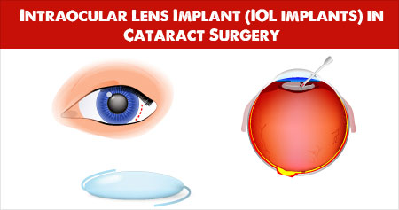 Bariatric Surgery - Gastric Bypass Procedure