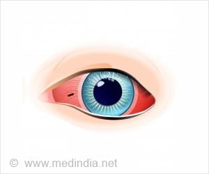 foreign body in eye
