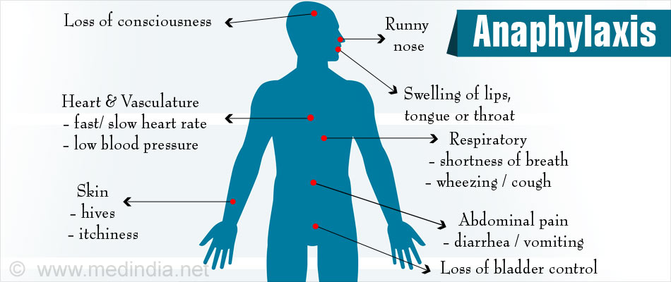 Anaphylaxis - Causes, Diagnosis, Treatment and Coping