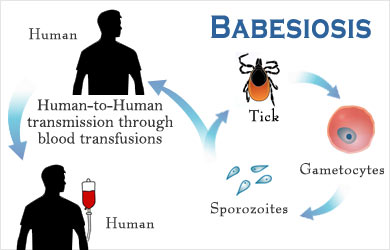 Babesiosis | Babesia - Causes, Symptoms, Diagnosis, Treatment