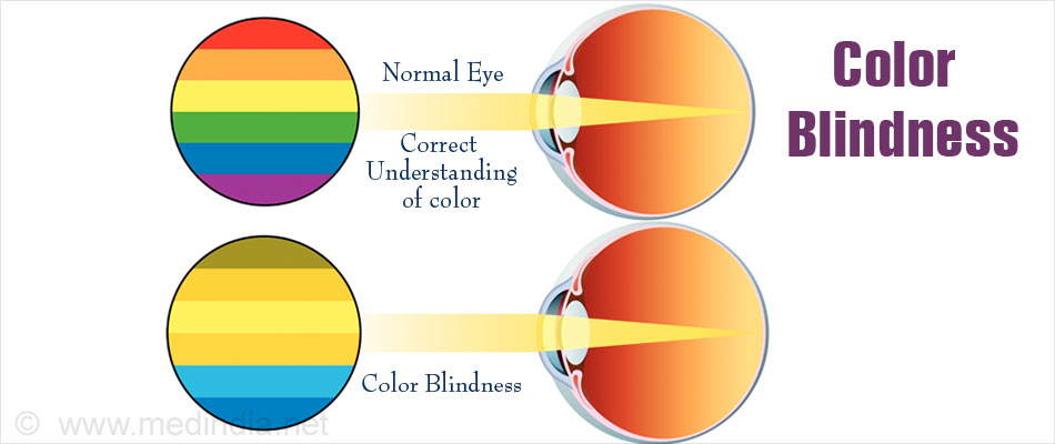 Color Blindness Types Causes Symptoms Diagnosis Treatment