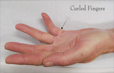 Dupuytren’s Contracture | Viking’s Disease - Causes, Risk Factors ...