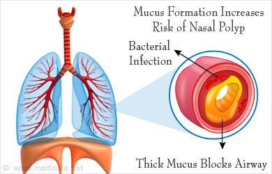 Nasal Polyp - Causes, Symptoms, Diagnosis, Treatment, Health Tips